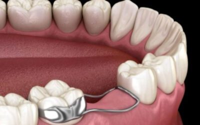 O que é um aparelho mantenedor de espaço?