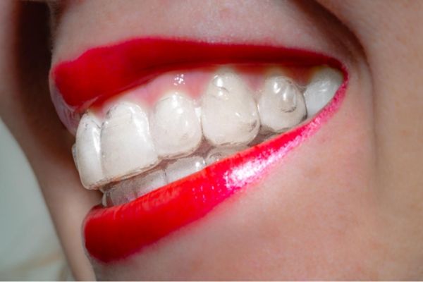 Alinhador Invisível Ortodôntico Para O Tratamento Dos Dentes Foto de Stock  - Imagem de inovativo, implante: 74230812