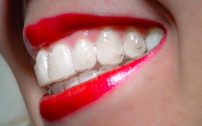 O que são os attachments do Invisalign?