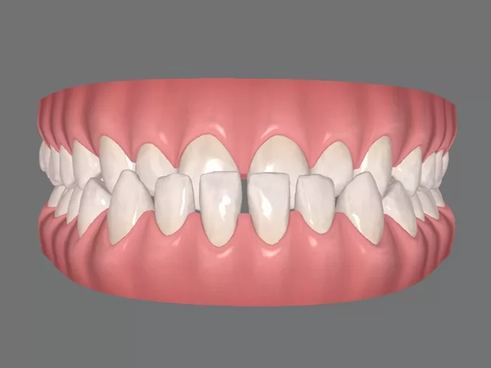 O que é o Prognatismo Mandibular