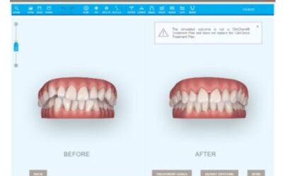Como funciona a consulta de avaliação para o Invisalign?