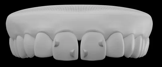Minimal attachments (novidades no tratamento Invisalign)