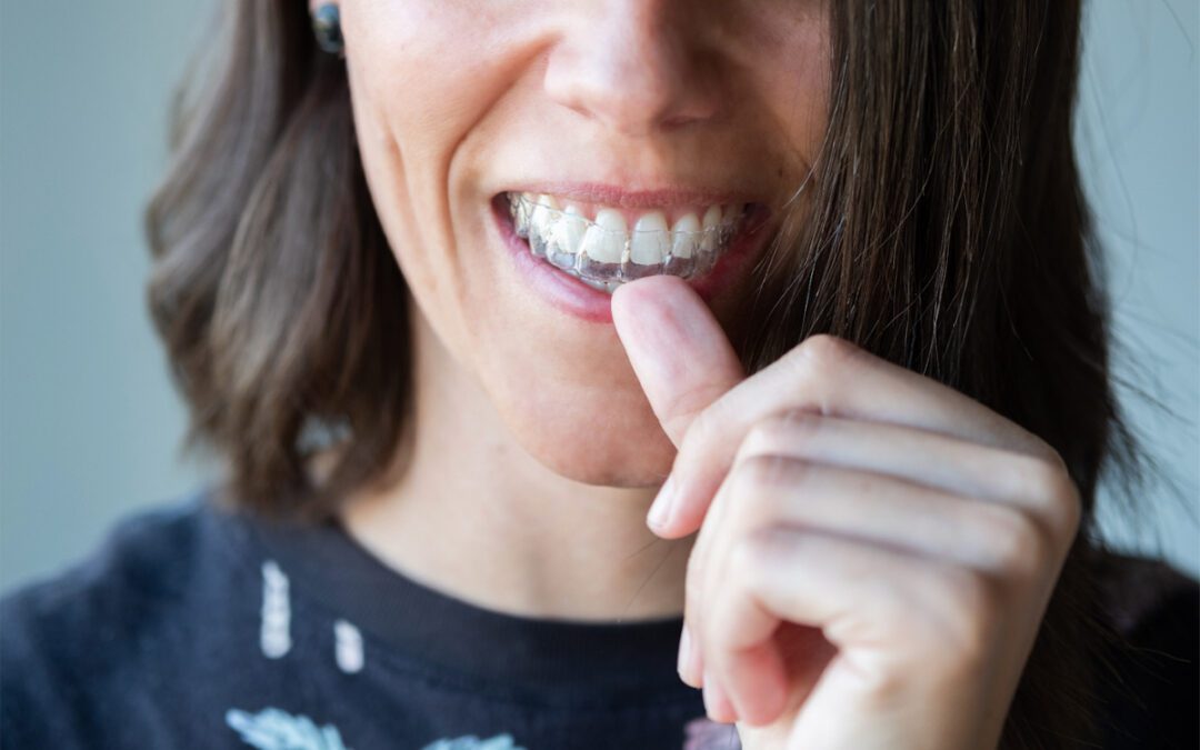 Posso usar alinhador invisível depois dos 40 anos?