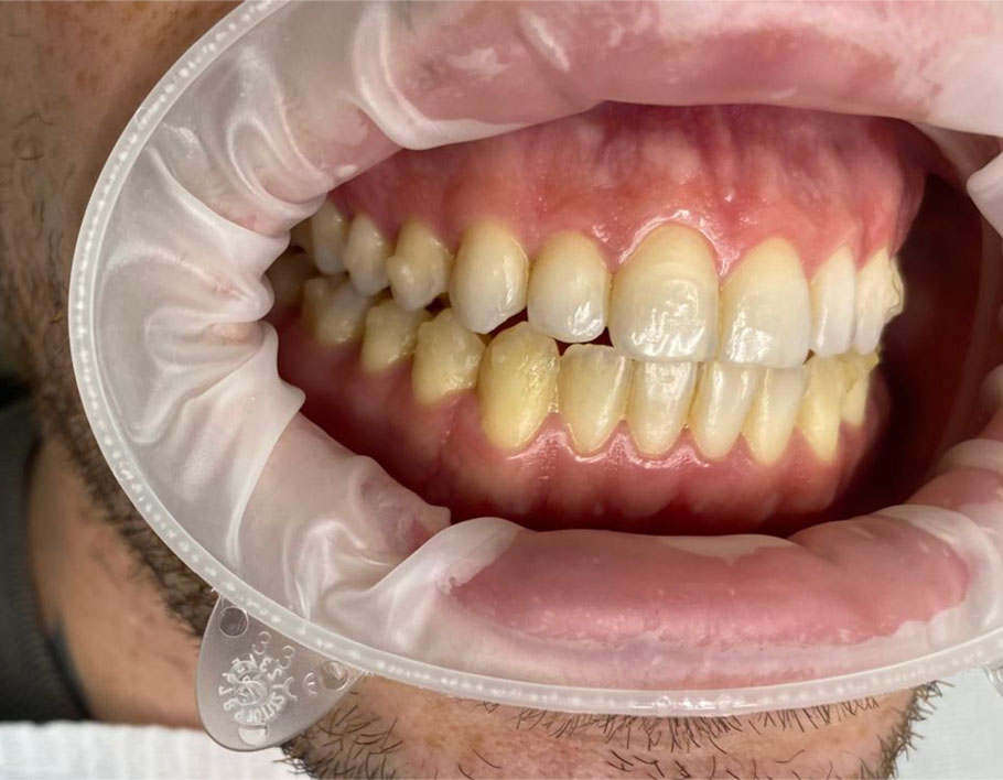 Antes do tratamento – paciente em tratamento ortodôntico com alinhadores Invisalign Antes do tratamento – paciente em tratamento ortodôntico com alinhadores Invisalign<br />