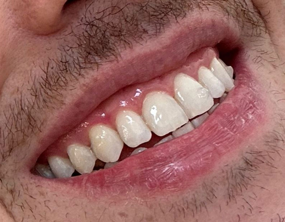 Depois do tratamento – profilaxia com AirFlow combinada com clareamento realizado no consultório Depois do tratamento – profilaxia com AirFlow combinada com clareamento realizado no consultório