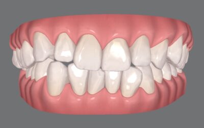 É possível tratar dentes apinhados ou encavalados com Invisalign?