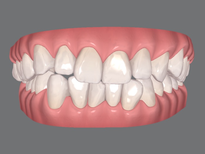 Uso do laser de baixa potência no tratamento da herpes labial