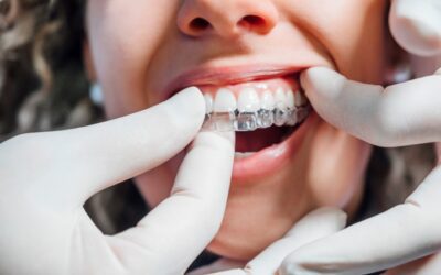 O que fazer quando o alinhador Invisalign não encaixa?