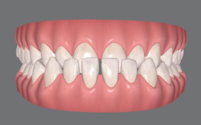 É possível tratar prognatismo mandibular com Invisalign?