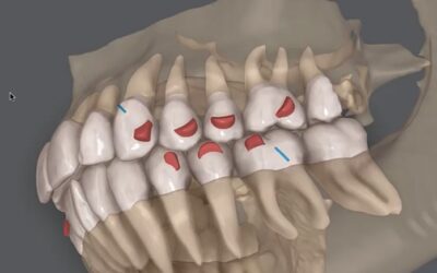 Tomografia integrada ao Clincheck do Invisalign