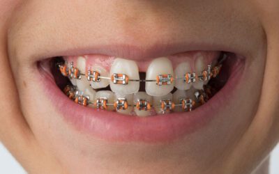 Por que a limpeza dental com AirFlow é importante para quem usa aparelho ortodôntico?