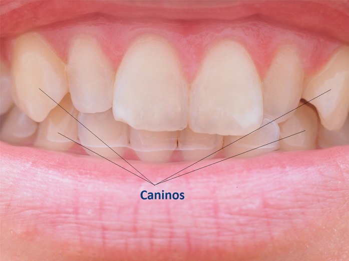 Por que os dentes caninos são os mais amarelados?