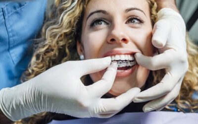 Como são as consultas de manutenção do Invisalign