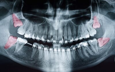 Preciso mesmo extrair o dente do siso? Quando é recomendado?