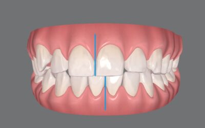 É possível tratar o desvio de linha média com Invisalign?
