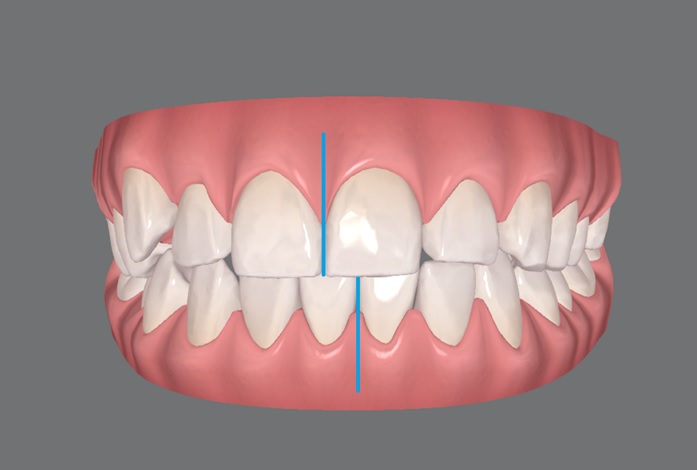 Uso do laser de baixa potência no tratamento da herpes labial