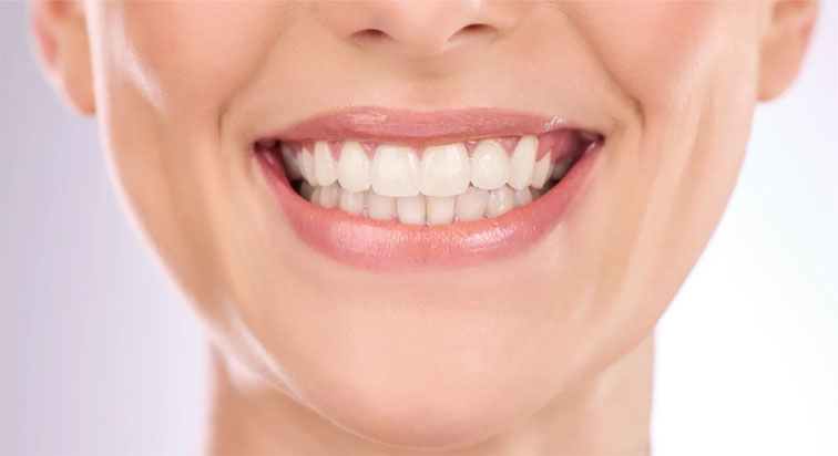 Depois do tratamento – profilaxia com AirFlow combinada com clareamento realizado no consultório Depois do tratamento – profilaxia com AirFlow combinada com clareamento realizado no consultório