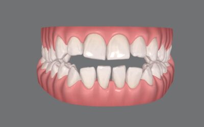 É possível tratar mordida aberta com Invisalign?