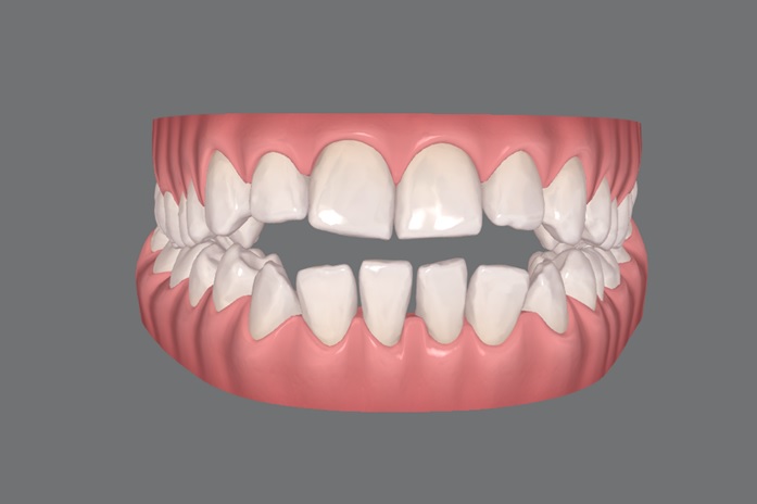 Uso do laser de baixa potência no tratamento da herpes labial