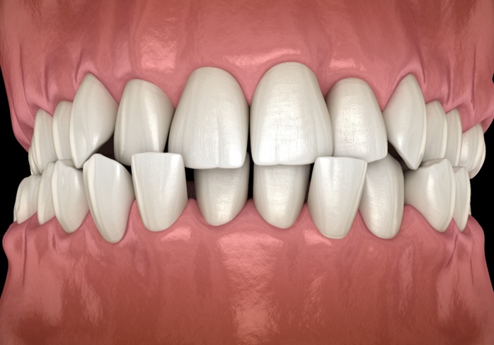 É possível tratar mordida cruzada com invisalign?