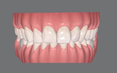 É possível tratar mordida profunda com Invisalign?