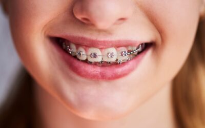 Recidiva: quando os dentes entortaram ou movimentaram depois de tirar o aparelho