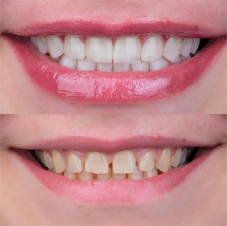 Facetas e lentes de contato em São Paulo Facetas e lentes de contato em São Paulo