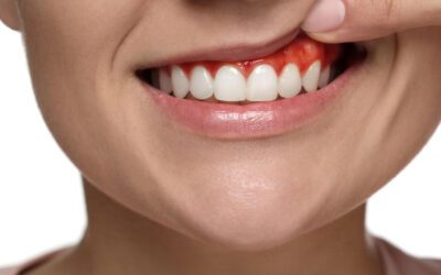Por que a limpeza dental (profilaxia) com AirFlow é importante para quem tem gengivite?