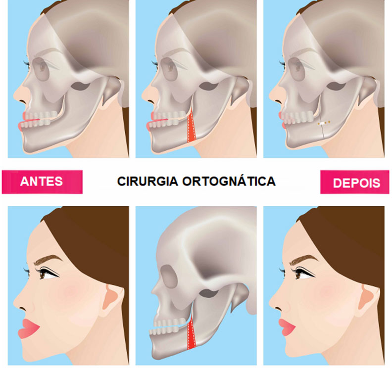 Como Funciona A Ortodontia Interceptativa Para Crian as 