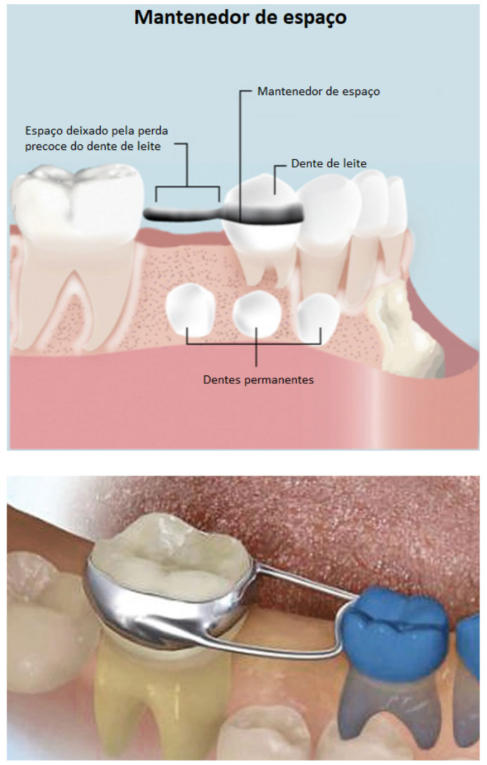 Exemplo de mantenedor de espaço utilizado no tratamento preventivo Exemplo de mantenedor de espaço utilizado no tratamento preventivo