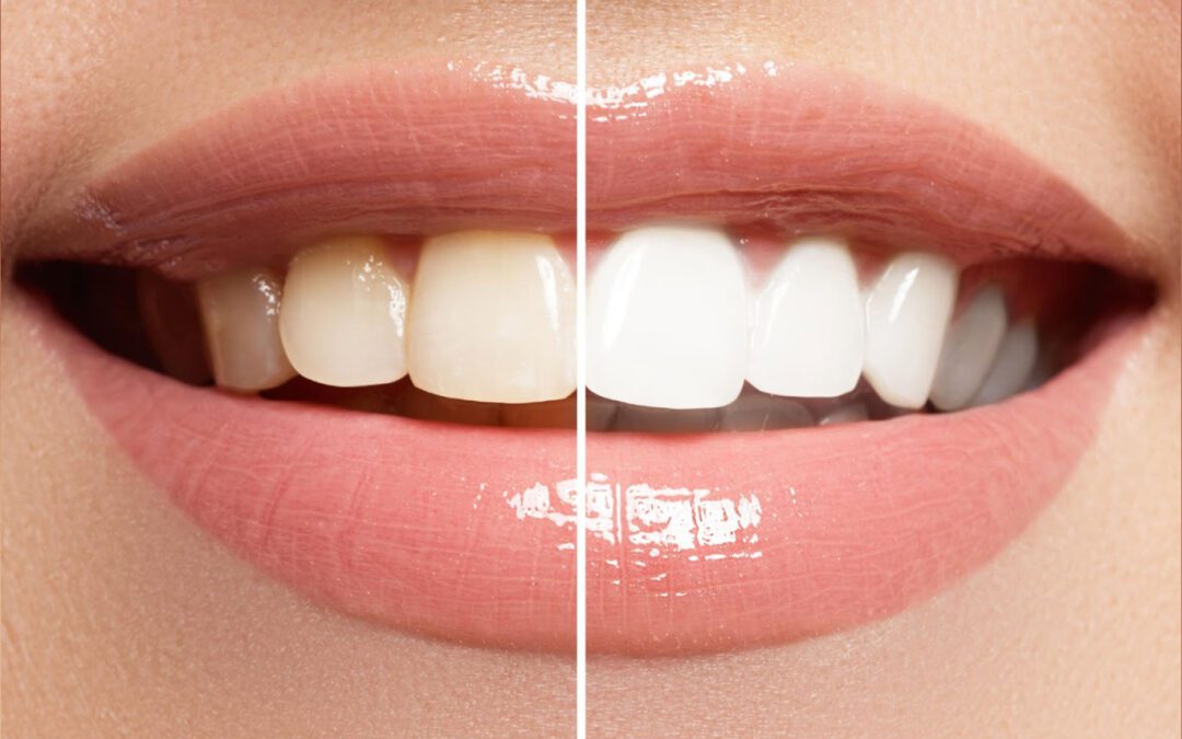 Clareamento dental: entenda os tipos, como funcionam e qual é o ideal para você?