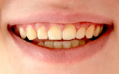 Dentes amarelados: por que isso acontece e o que pode ser feito?