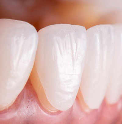 Facetas e lentes de contato em São Paulo