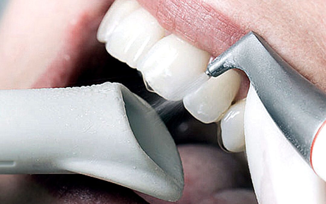 Limpeza Dental: Como Funciona? Quando é Recomendada?