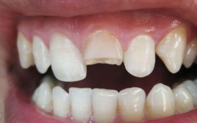 Meu dente quebrou… e agora, o que fazer?