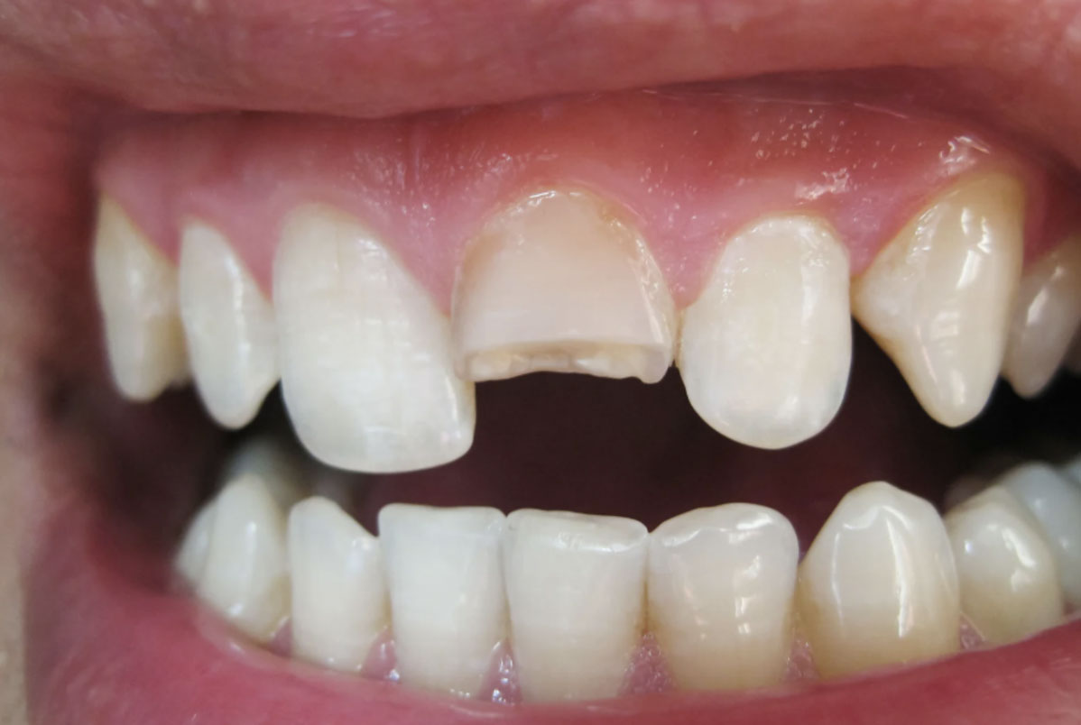 Meu dente quebrou... e agora, o que fazer? Meu dente quebrou... e agora, o que fazer?