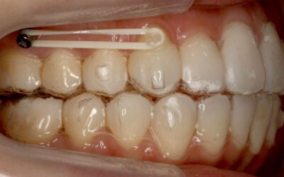 Mini-implantes no tratamento com Invisalign: o que são e por que são utilizados?