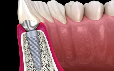 Por que a limpeza dental com AirFlow é importante para quem tem implante?