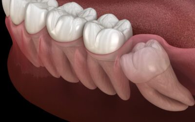 Preciso extrair o dente do siso antes do tratamento com Invisalign?