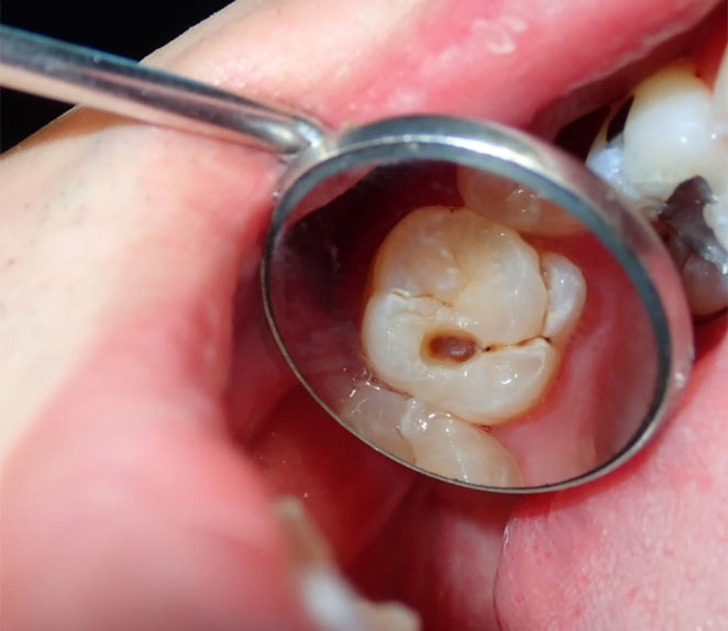 Quando uma restauração é indicada? Quando uma restauração é indicada?