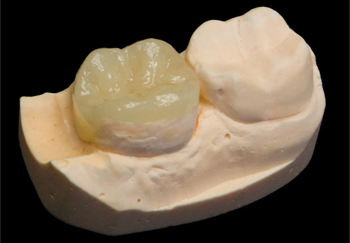 Restauração onlay Restauração onlay