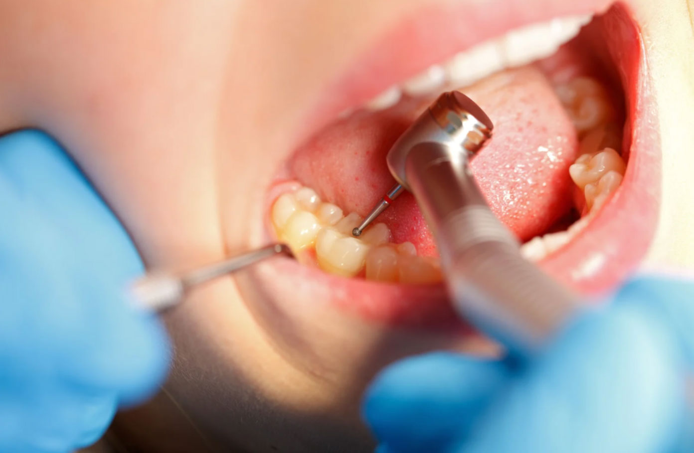 Restaurações Dentárias Restaurações Dentárias