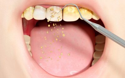 O que é tártaro, como se forma e como cuidar?