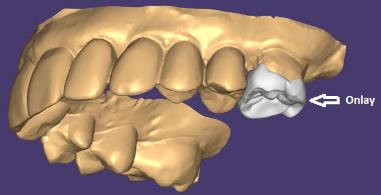 Exemplo de um desenho do projeto de uma prótese onlay Exemplo de um desenho do projeto de uma prótese onlay<br />