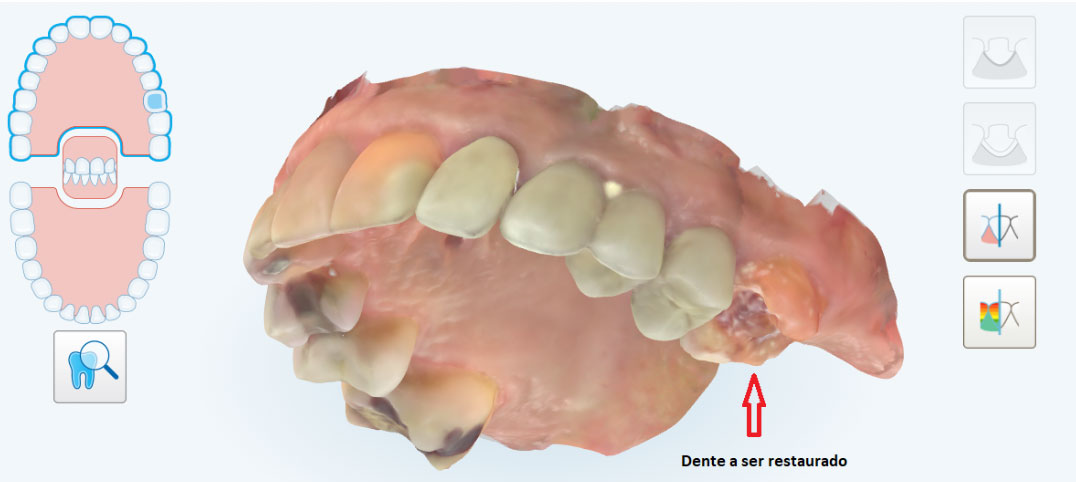 Escaneamento pelo iTero para confecção de onlay Escaneamento pelo iTero para confecção de onlay<br />