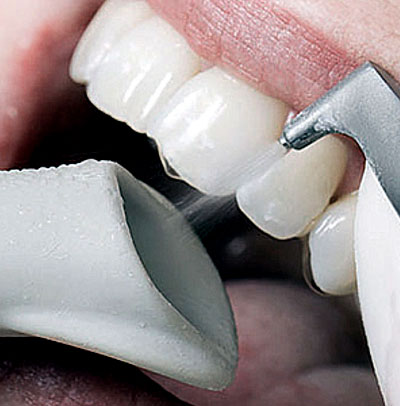 Limpeza dental com AirFlow