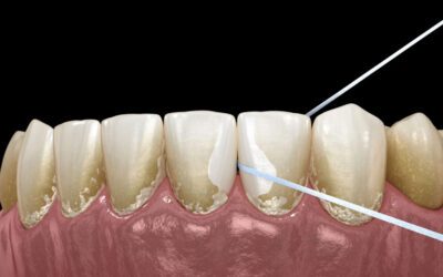 Placa bacteriana: o que é, por que aparece e como cuidar da sua saúde bucal com carinho
