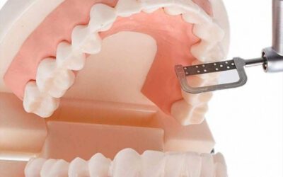 Desgastes interproximais no tratamento com Invisalign