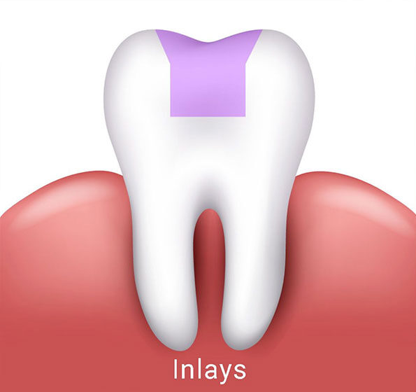 prótese dentária - Inlays, em São Paulo. prótese dentária - Inlays, em São Paulo.