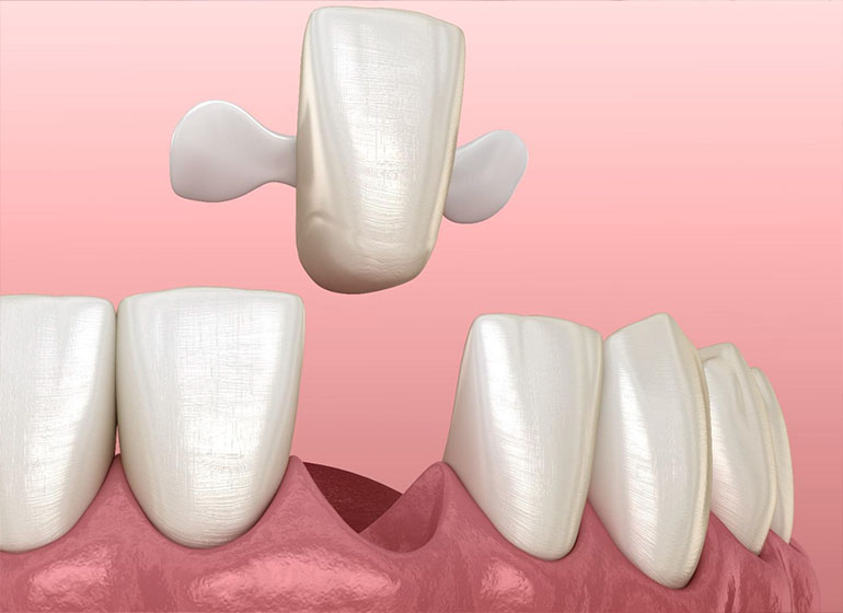 prótese dentária - Próteses Adesivas, em São Paulo. prótese dentária - Próteses Adesivas, em São Paulo.